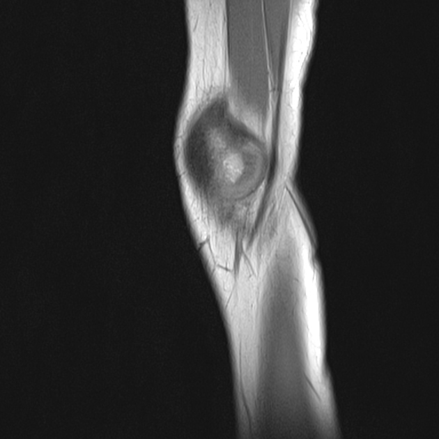 Brodies abscess Radiology Case Radiopaedia