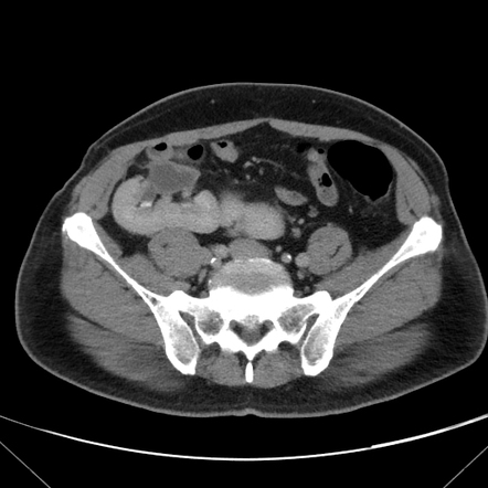 Bilateral pelvic kidneys with PUJ obstruction, fusion and right-sided ...