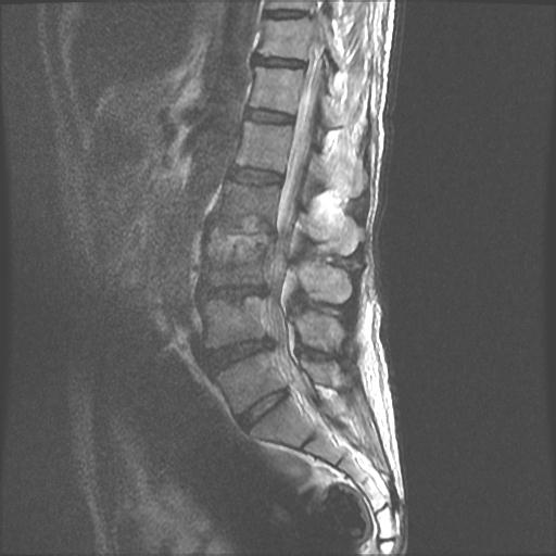 Spondylodiscitis | Image | Radiopaedia.org