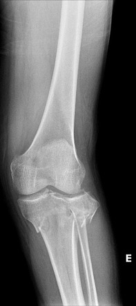 Tibial plateau fracture - Schatzker type VI | Radiology Case ...