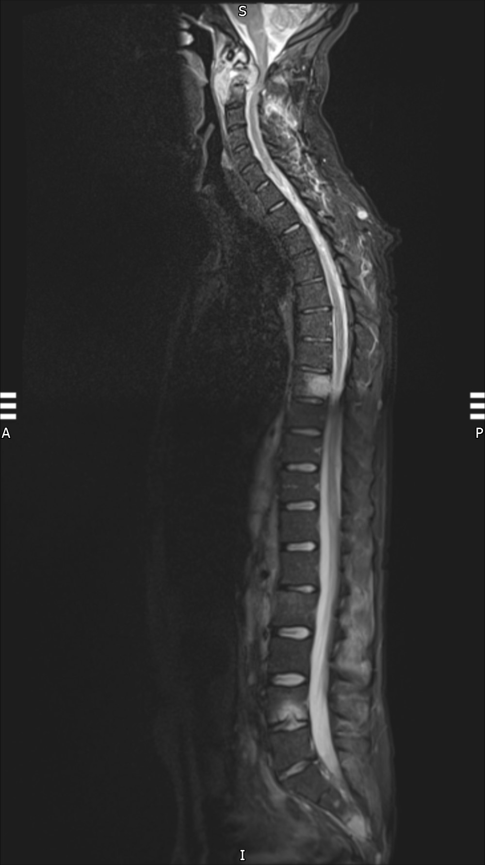 Metastatic melanoma - presented post neck injury | Image | Radiopaedia.org