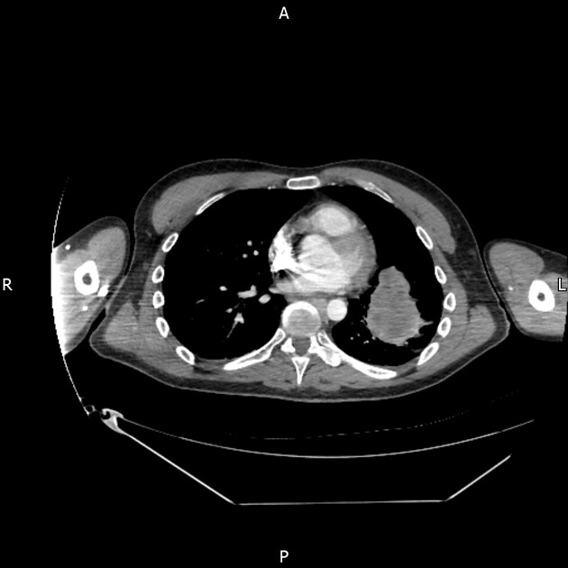 CT neck chest abdomen pelvis NCAP protocol Radiology