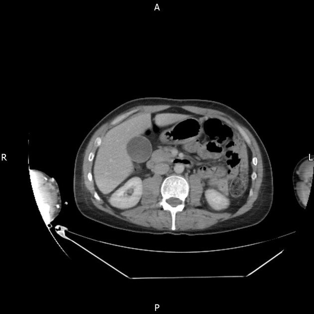 CT neck chest abdomen pelvis NCAP protocol Radiology