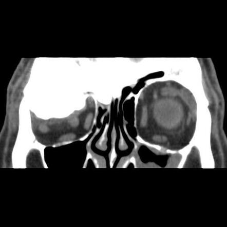 Giant frontal sinus osteoma | Radiology Case | Radiopaedia.org