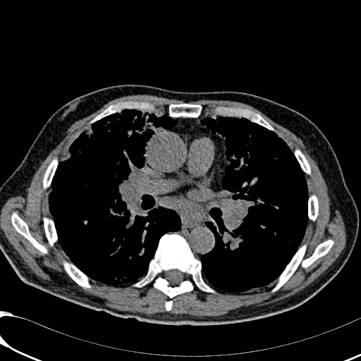 Lymphangitic Carcinomatosis Image