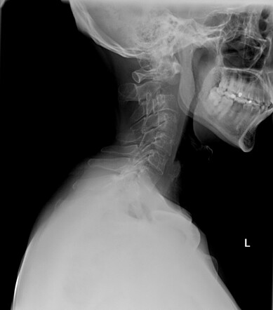 Metastatic melanoma - presented post neck injury | Radiology Case ...