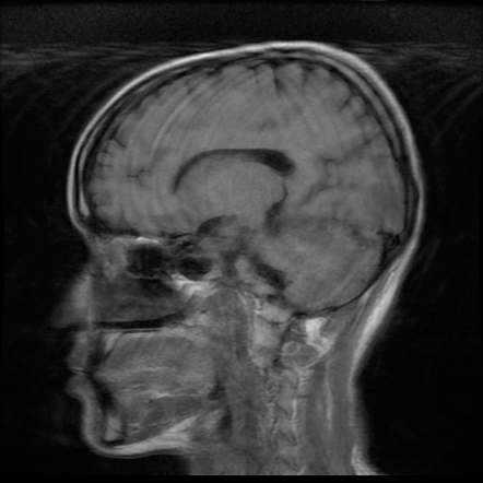 Posterior reversible encephalopathy syndrome (PRES) | Image ...