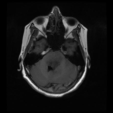 Diffuse brainstem glioma | Radiology Case | Radiopaedia.org