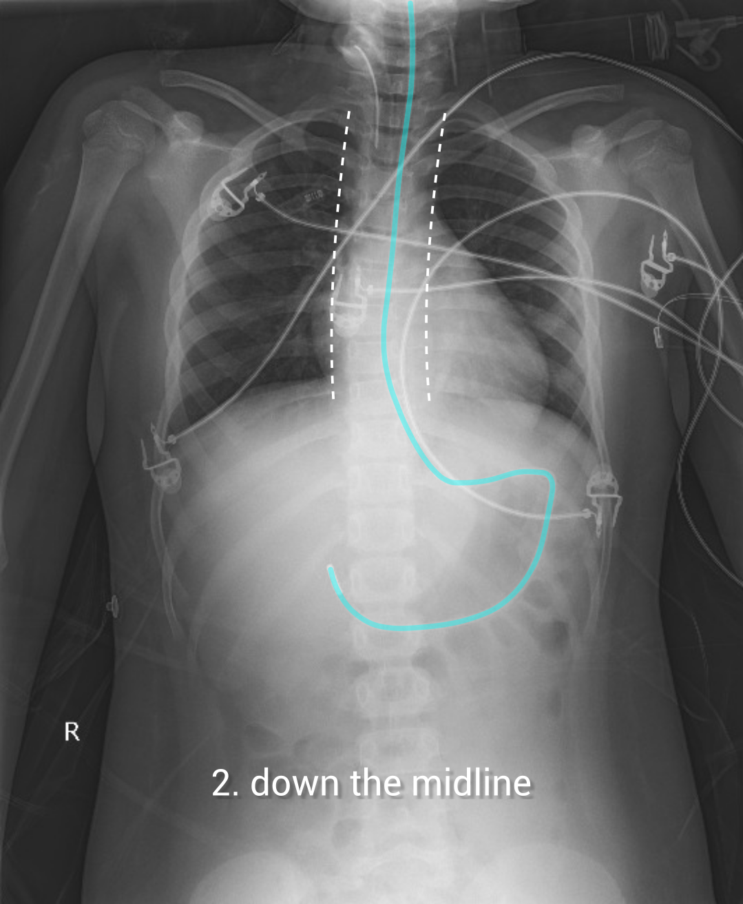 Nasogastric tube position confirmation | Image | Radiopaedia.org