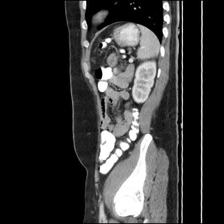 Fibrous dysplasia of the rib | Image | Radiopaedia.org