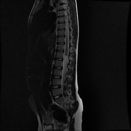 Caudal regression syndrome | Radiology Case | Radiopaedia.org