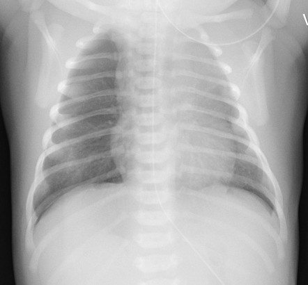 Meconium aspiration | Radiology Case | Radiopaedia.org