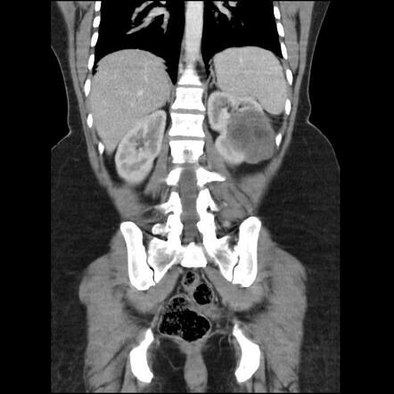 Renal Cell Carcinoma Radiology Case Radiopaedia Org