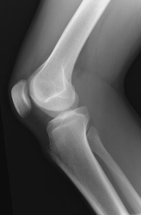 Osgood-Schlatter disease | Radiology Reference Article | Radiopaedia.org