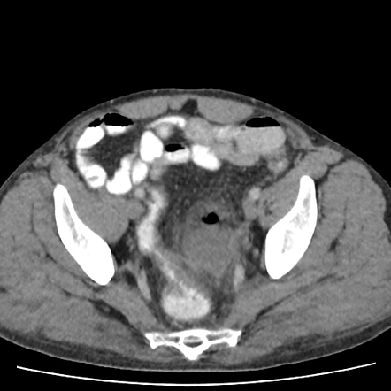 Sigmoid colon perforation caused by ingested toothpick | Image ...