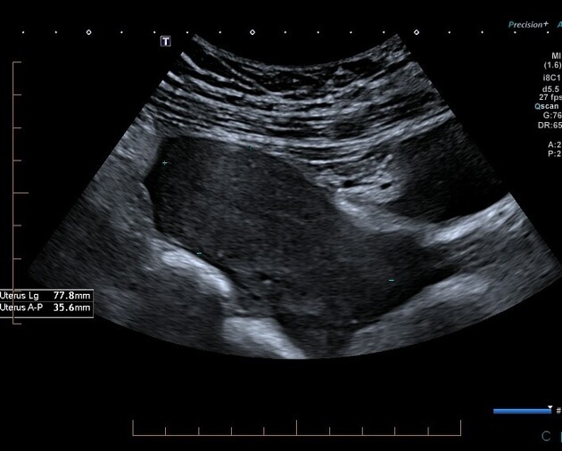 ectopic pregnancy ultrasound