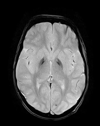 Hallervorden-Spatz syndrome | Radiology Case | Radiopaedia.org