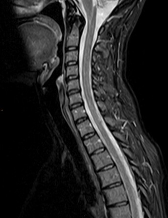 Normal cervical spine MRI | Image | Radiopaedia.org