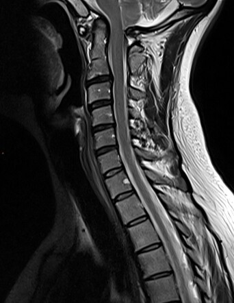 Basilar invagination | Radiology Case | Radiopaedia.org