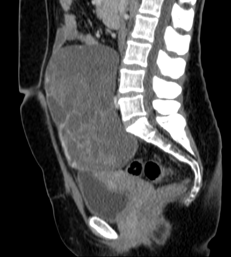 Krukenberg Tumor 