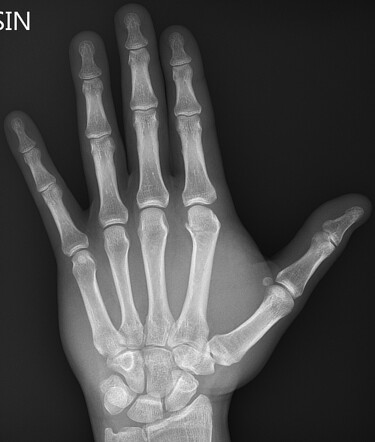 Metacarpal fracture | Radiology Reference Article | Radiopaedia.org