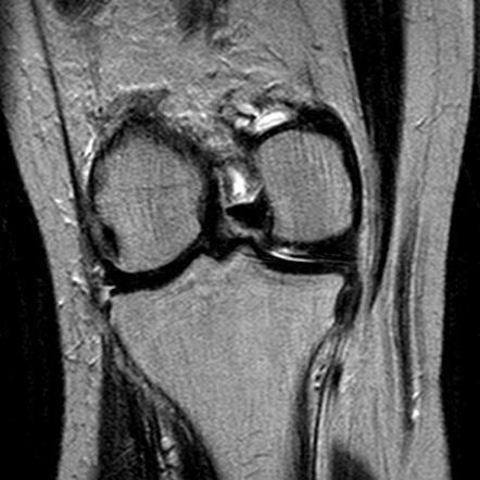 Lipoma arborescens | Image | Radiopaedia.org