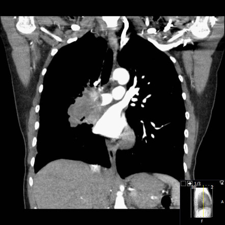 Pulmonary Artery Sarcoma 