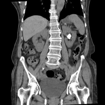 Colon diverticulosis | Radiology Case | Radiopaedia.org