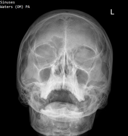 Orbital emphysema | Radiology Case | Radiopaedia.org