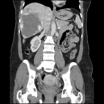 Liver hemangioma | Radiology Case | Radiopaedia.org