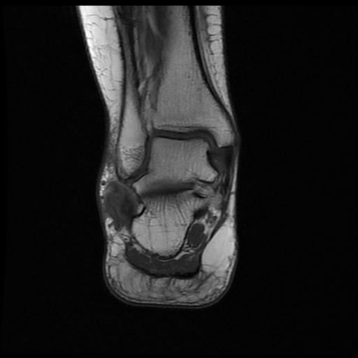 Peroneus brevis split tear | Image | Radiopaedia.org