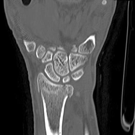 Distal radius fracture | Radiology Case | Radiopaedia.org