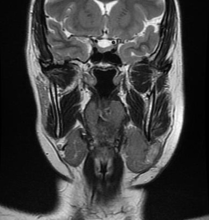 Lymphoepithelial carcinoma - submandibular gland | Image | Radiopaedia.org