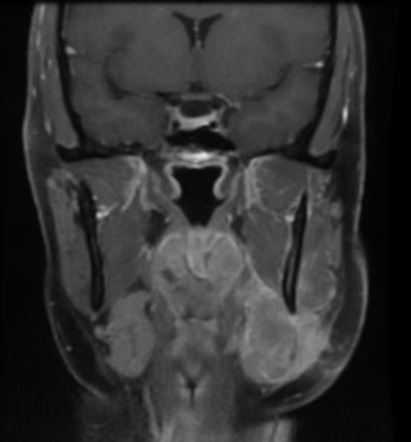 Lymphoepithelial carcinoma - submandibular gland | Radiology Case ...