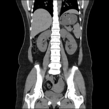 mature cystic teratoma right ovary icd 10