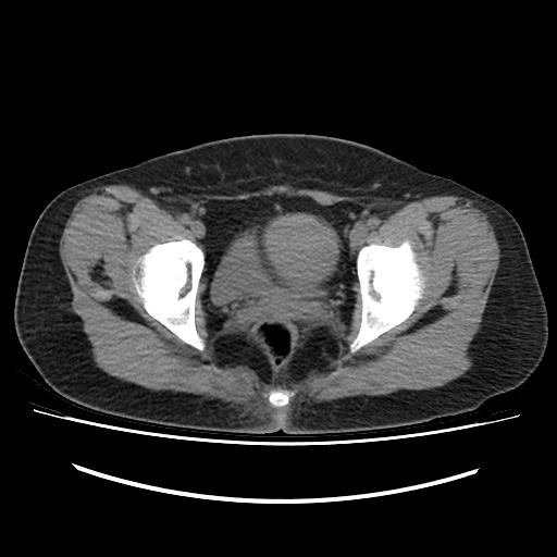 Mature cystic teratoma of right ovary | Image | Radiopaedia.org