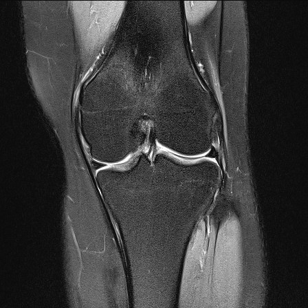 Normal MRI Knee | Image | Radiopaedia.org