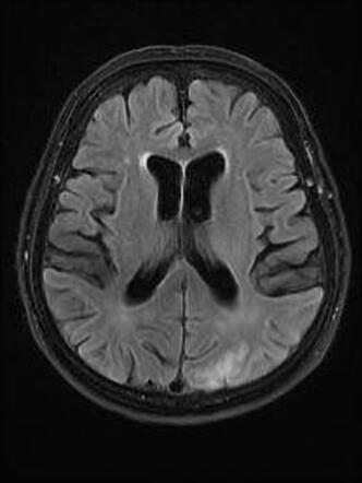 Inflammatory cerebral amyloid angiopathy | Radiology Reference Article ...