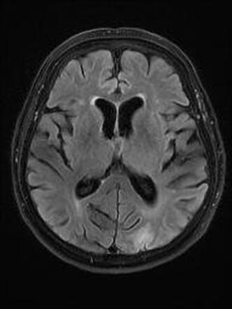 Cerebral amyloid angiopathy-related inflammation (CAA-RI) | Image ...