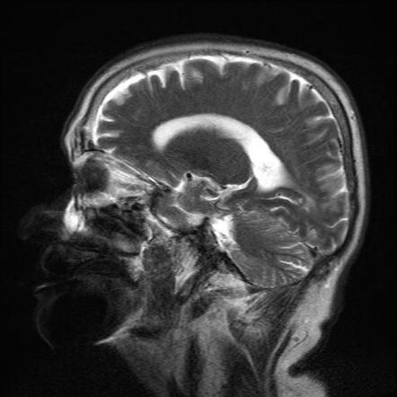 Cerebral Amyloid Angiopathy-related Inflammation (CAA-RI) | Image ...