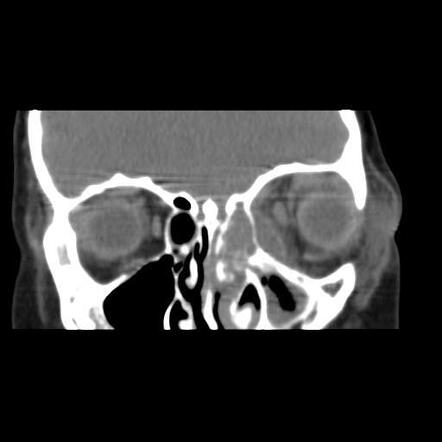 Subperiosteal abscess of the orbit | Radiology Case | Radiopaedia.org