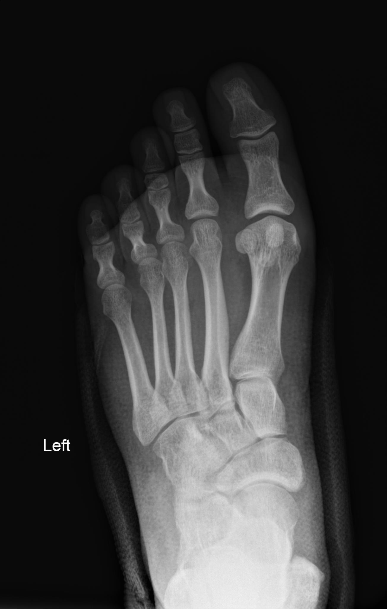 Dorsal avulsion fracture of the navicular bone | Image | Radiopaedia.org