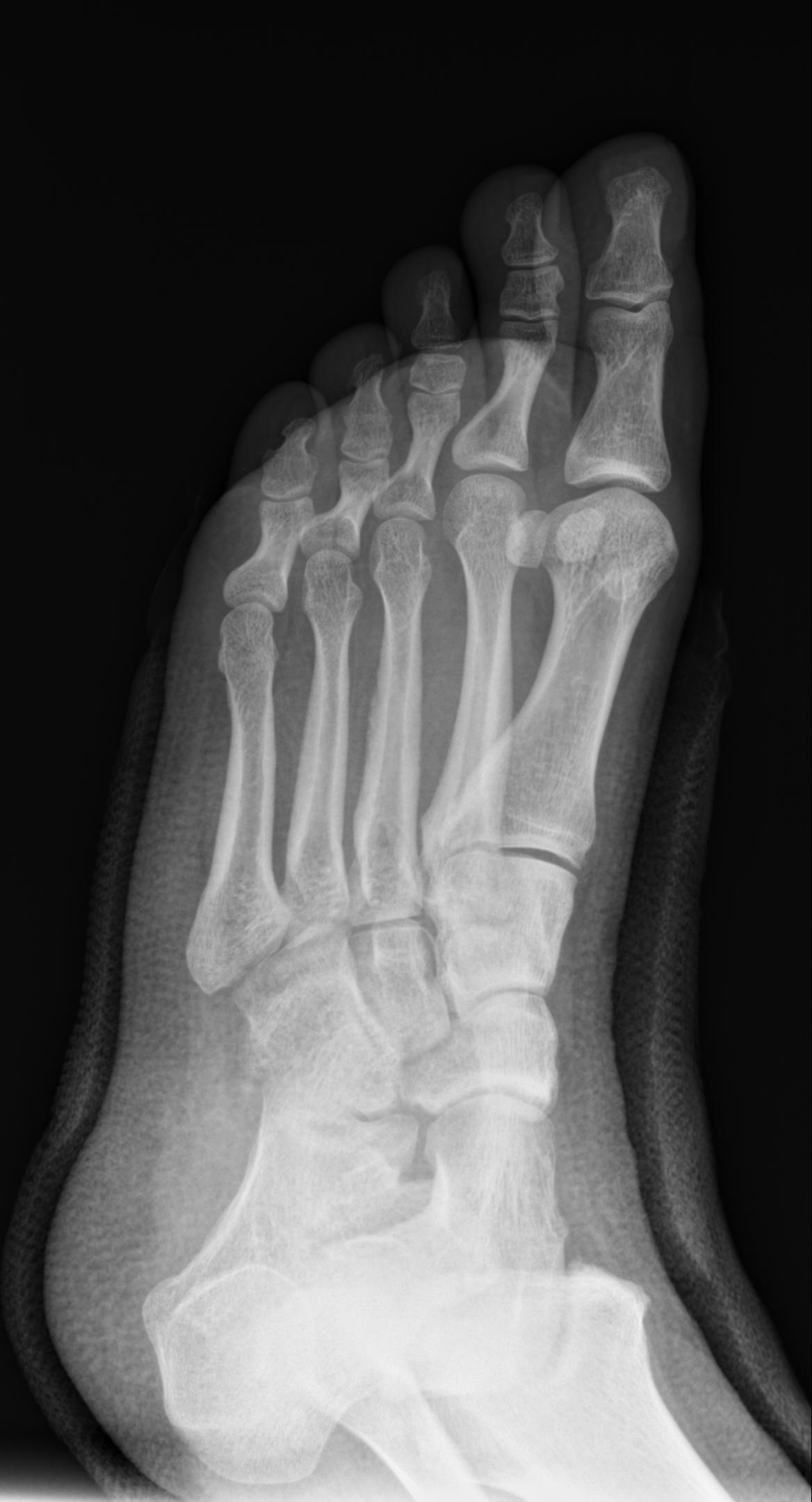 Dorsal Avulsion Fracture Of The Navicular Bone Image 1873