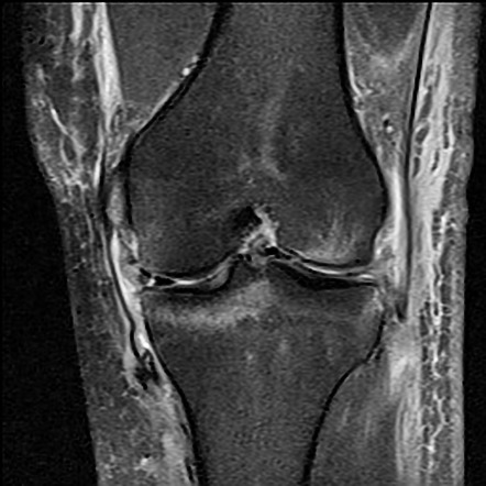 Stener-like lesion of the superficial medial collateral ligament ...