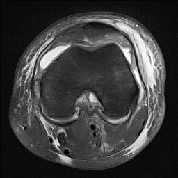 Stener-like Lesion Of The Superficial Medial Collateral Ligament ...