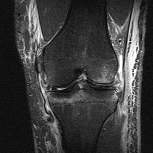 Stener-like lesion of the superficial medial collateral ligament ...