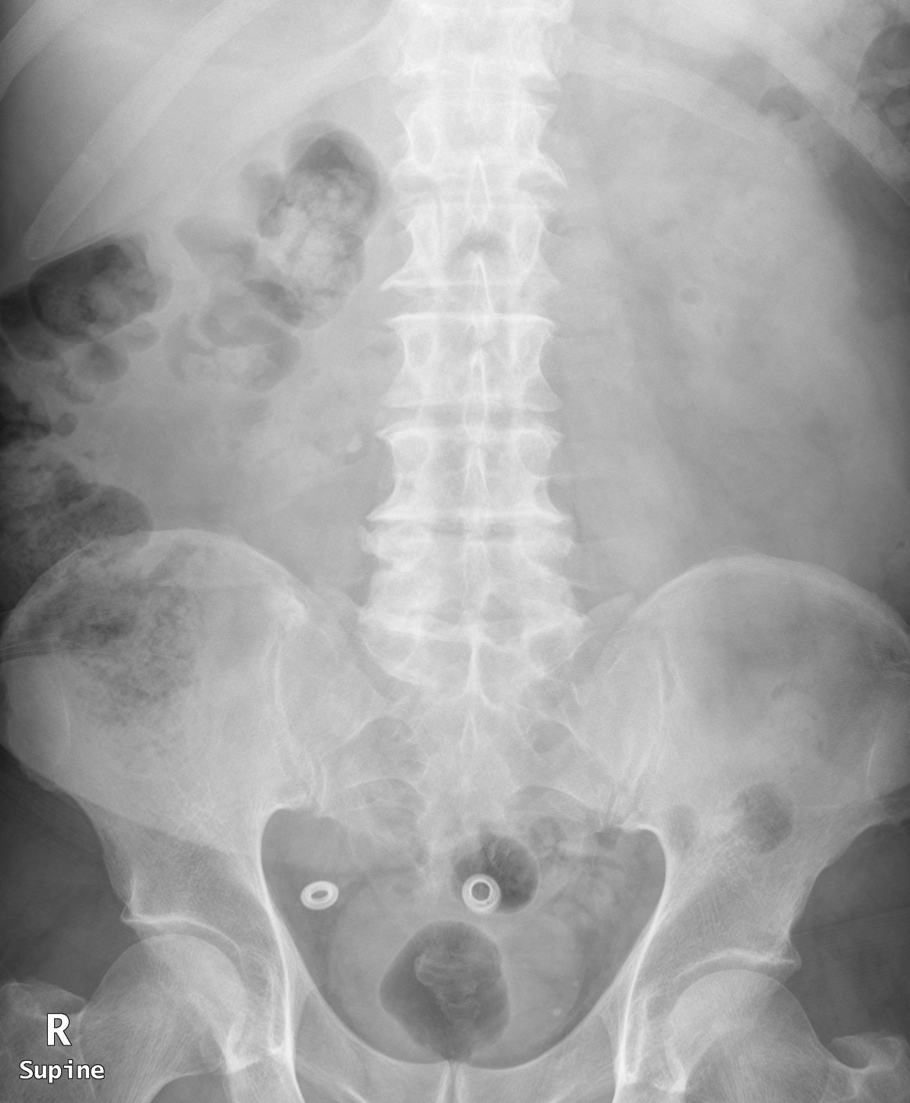 Right renal stone | Image | Radiopaedia.org