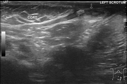 Atrophic testis | Radiology Case | Radiopaedia.org