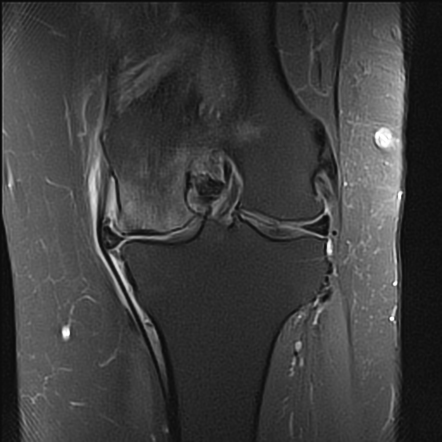 Posterior root tear and subchondral insufficiency fracture | Radiology ...