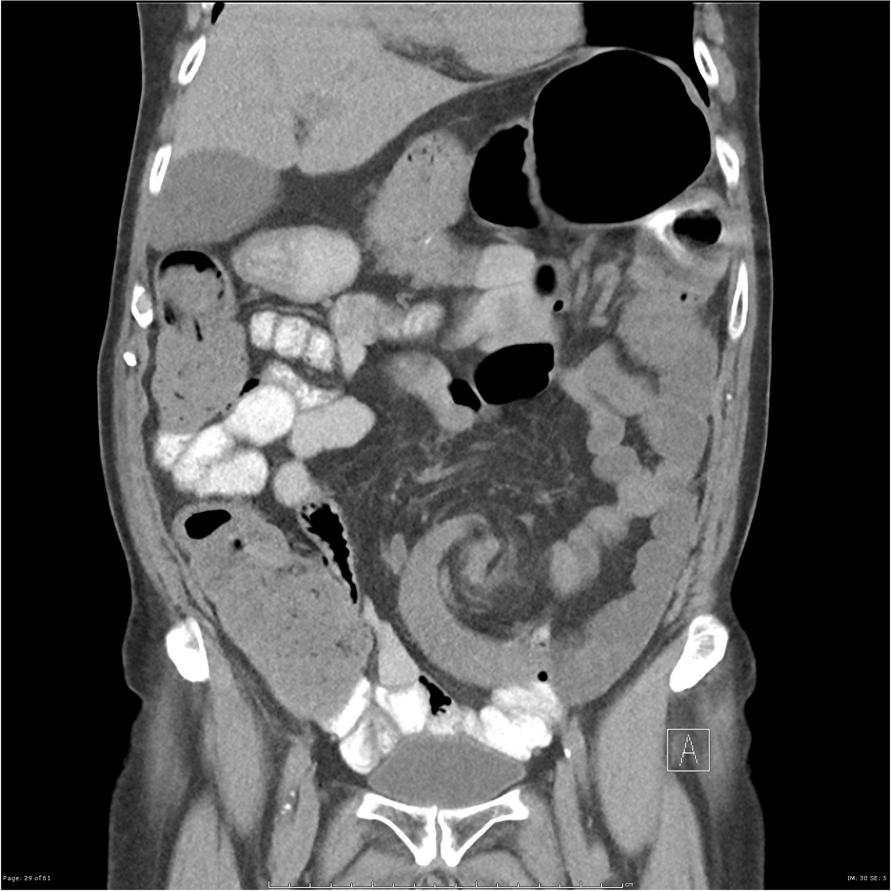 Sigmoid volvulus | Image | Radiopaedia.org